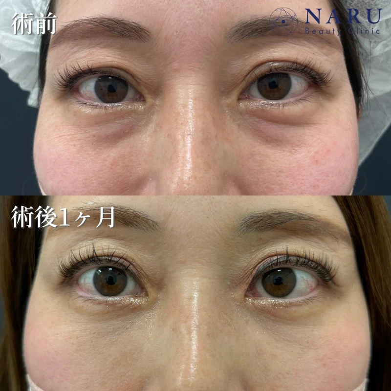 公式サイトの症例（切らないクマ取り・40代女性の術前と術後1ヶ月・2例目）