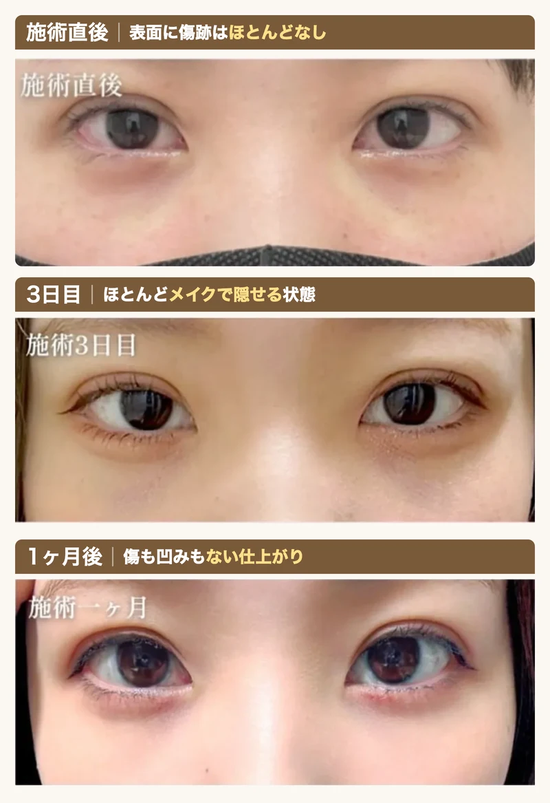 施術直後・3日目・1ヶ月後の経過（傷跡ほぼなし・メイクで隠せる・傷も凹みもなし）